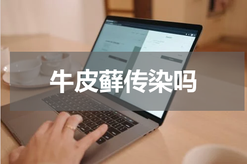 牛皮藓传染吗
