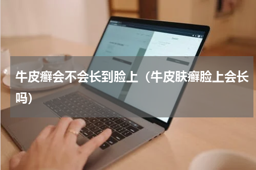 牛皮癣会不会长到脸上（牛皮肤癣脸上会长吗）