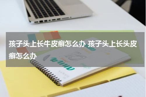 孩子头上长牛皮癣怎么办 孩子头上长头皮癣怎么办