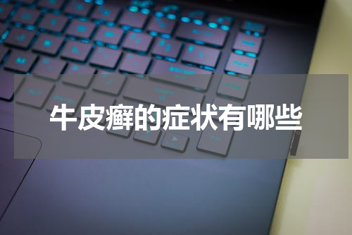 牛皮癣的症状有哪些