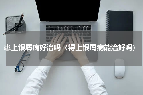患上银屑病好治吗（得上银屑病能治好吗）