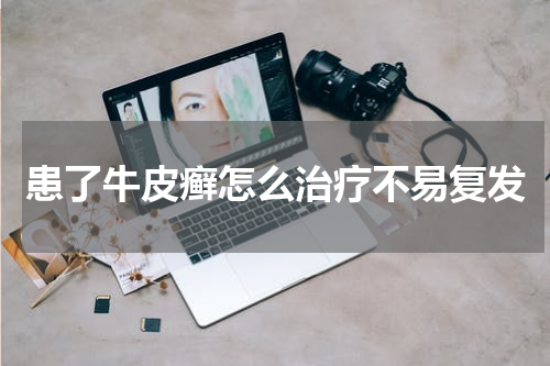 患了牛皮癣怎么治疗不易复发