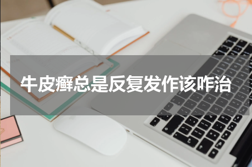 牛皮癣总是反复发作该咋治