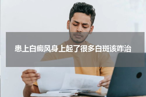 患上白癜风身上起了很多白斑该咋治