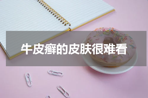 牛皮癣的皮肤很难看