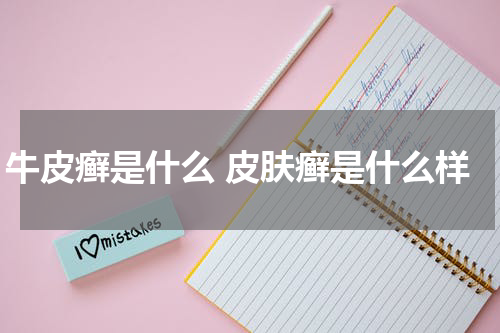 牛皮癣是什么 皮肤癣是什么样