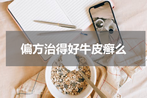 偏方治得好牛皮癣么