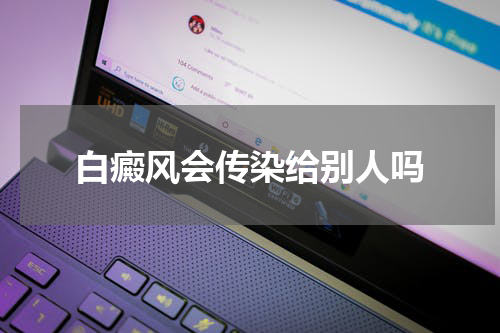 白癜风会传染给别人吗