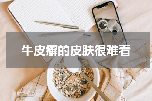 牛皮癣的皮肤很难看