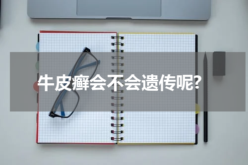 牛皮癣会不会遗传呢?