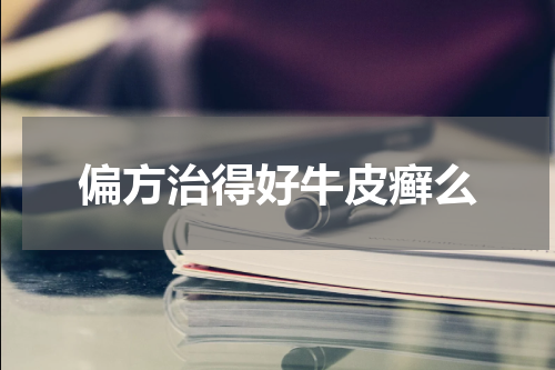 偏方治得好牛皮癣么