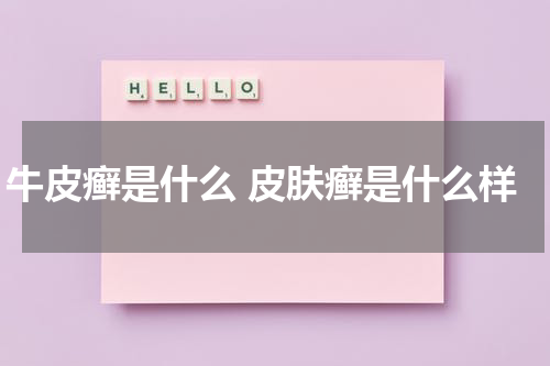 牛皮癣是什么 皮肤癣是什么样