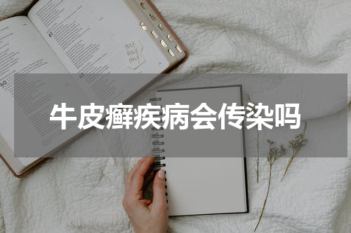 牛皮癣疾病会传染吗